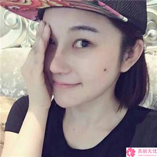 注入消炎针可以改良硅胶膨体隆鼻后出现的感染吗