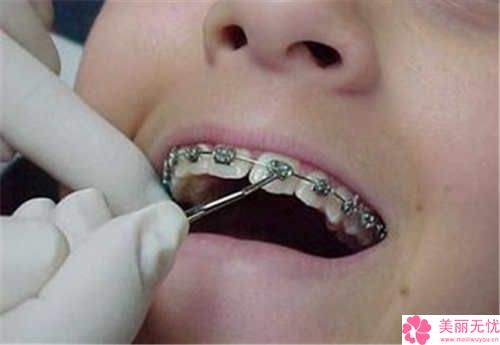 较适合矫正龅牙的牙套是什么类型的