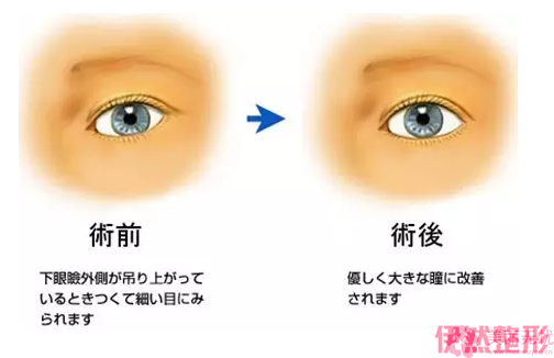 矫正一边上眼睑下垂多少块钱