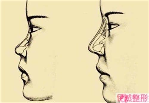 肋软骨隆鼻后鼻部会不会歪斜
