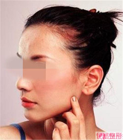 过敏性鼻炎的女性可以做耳软骨隆鼻吗
