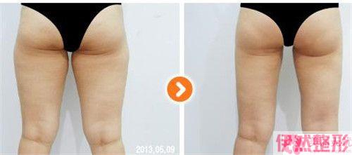 2000做去脂瘦臀踩雷了吗