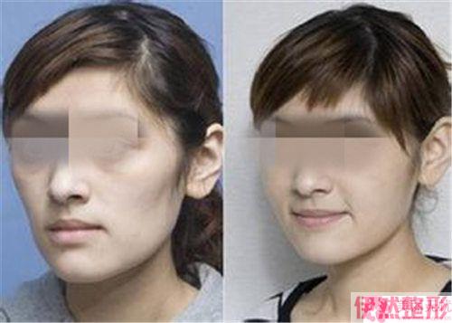 老牌的医师自体脂肪填充面颊有没有风险？