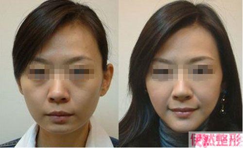 pst面部提升术恢复完成需要多久时间