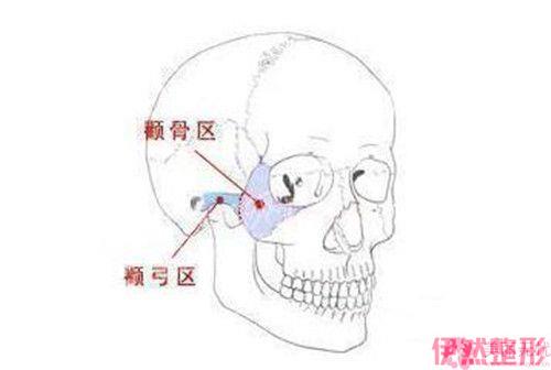 颧骨整形一个月果明X吗