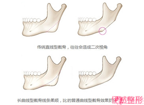 颧骨整形一个月果明X吗