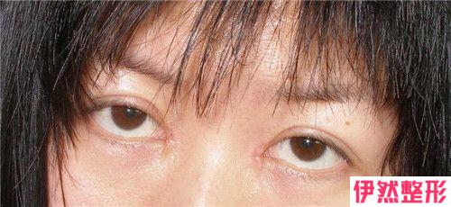 开外眼角手术可不可以改正内眦赘皮的遮盖