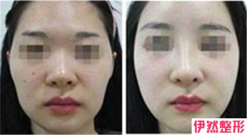 您知道电离子祛雀斑的风险吗？
