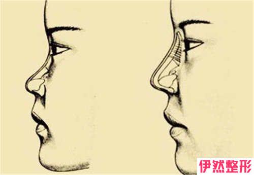 假体隆鼻手术整形果有哪些