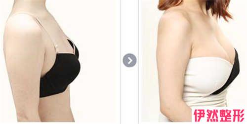 普遍的2类丰胸方式是那些?