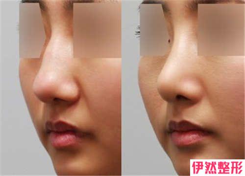 三段式鼻整形手术有危害吗？