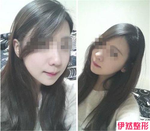 咬肌去除哪种方式没问题性高