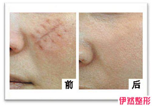 激光调节痤疮疤痕之后要怎么护理