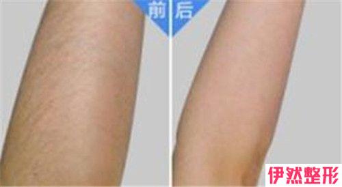 彩光脱唇毛不成功教你怎样处置