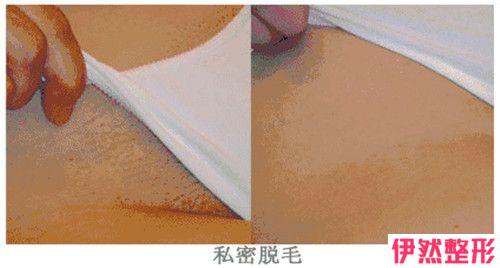 彩光脱唇毛不成功教你怎样处置