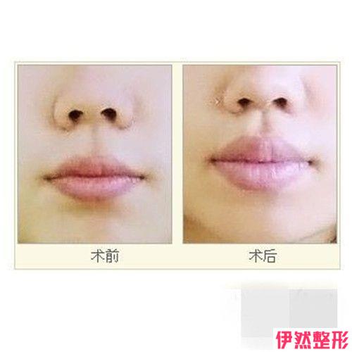薄唇增厚安不没问题 果好不好