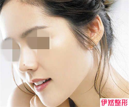 鼻窦炎患者可以实施筋膜隆鼻吗