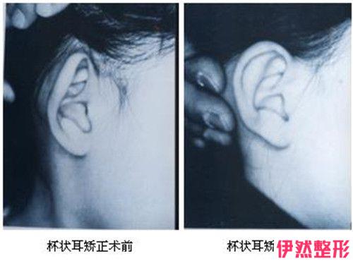 耳廓再造手术对人体是否有危害