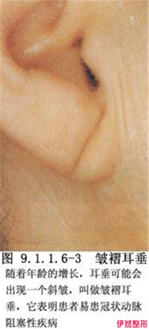 哪一些畸形耳垂症状可手术改良 