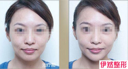射频溶脂瘦脸会不会影响健康呢