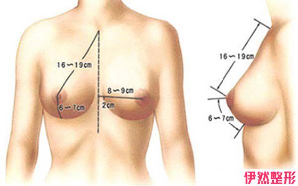 71703能做乳房下切口假体隆胸吗