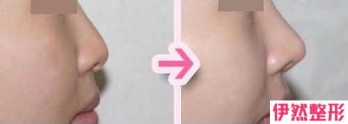二段式塑造鼻子形状之后，假体材料存在着露出皮肤层的百分比吗？