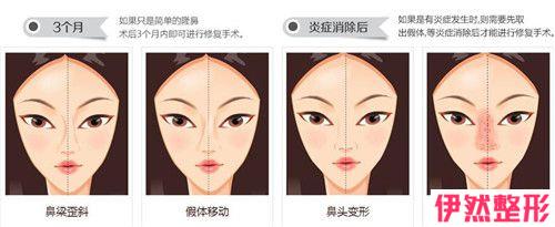 二段式塑造鼻子形状之后，假体材料存在着露出皮肤层的百分比吗？