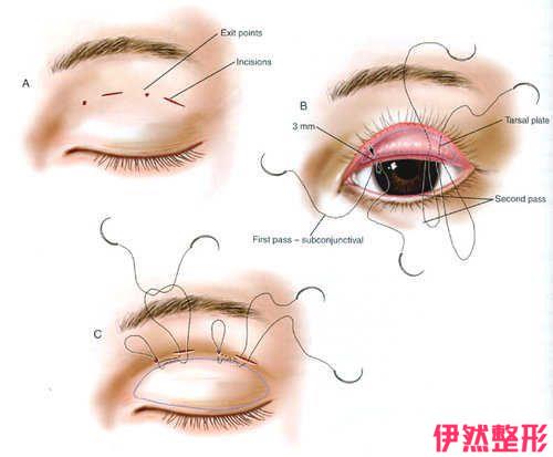 双眼皮手术后多久能洗脸，术后要怎么护理