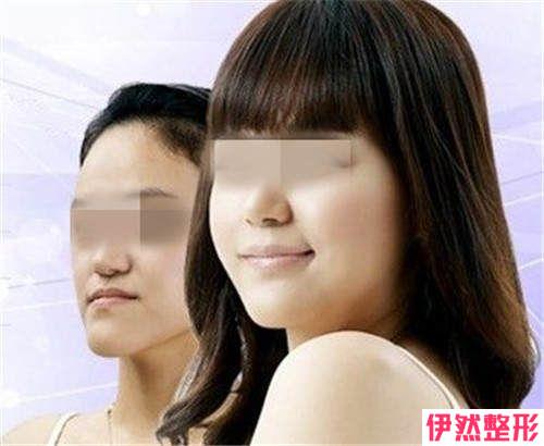 下颚填充透明质酸能做高强度动作吗
