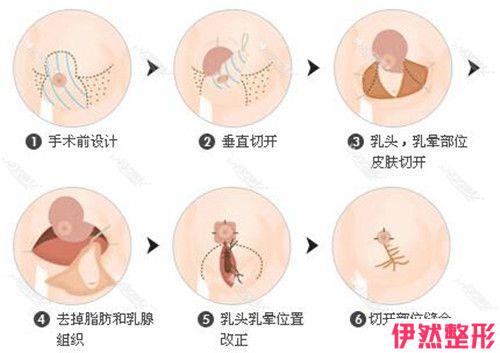 乳头内陷矫正手术如何进行术后护理