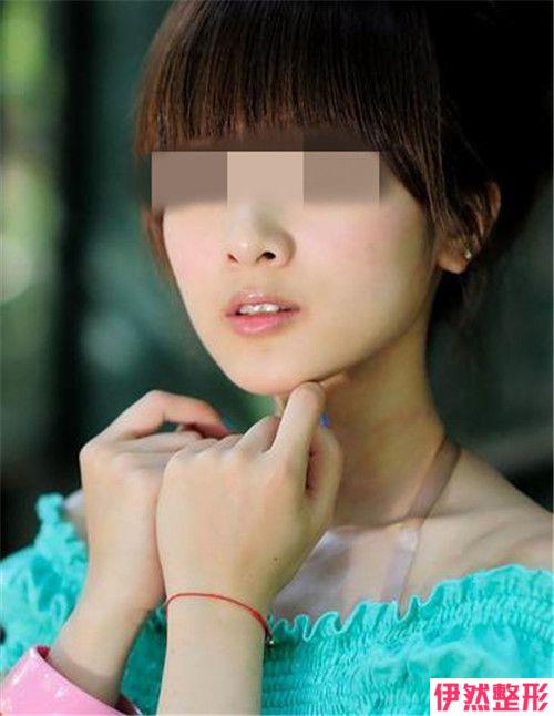 硅胶或膨体填充下巴整形的费用大概是多少