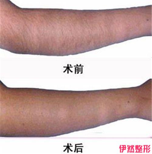 冰点脱毛前后有哪些注意事项