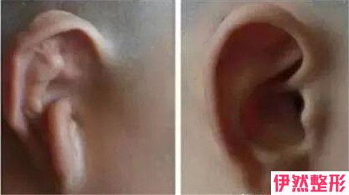 怎么做可以预防耳朵瘢痕疙瘩的复发