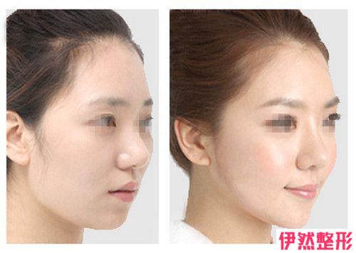 3D隆鼻手术后的如何护理