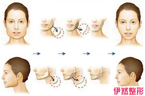 3d面部提升价格费用是多少钱