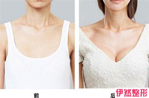 乳房下垂矫正术恢复时期有什么注意要点