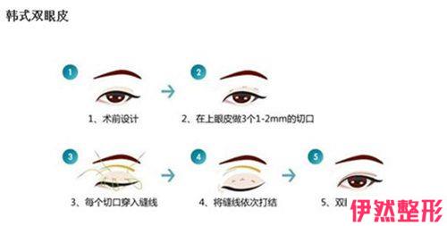 微创双眼皮手术得筹多少钱