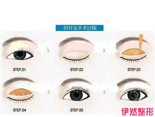 微创双眼皮手术得筹多少钱