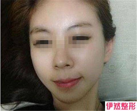 脂肪丰太阳穴价格一般要多少 