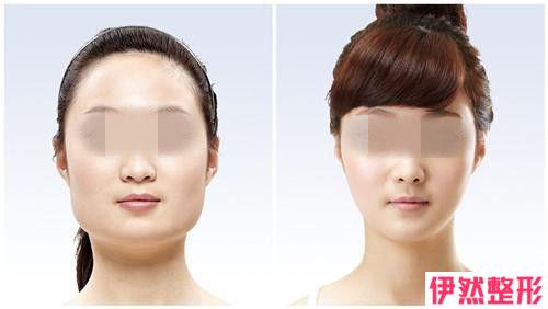 面部抽脂整形手术可能出现的后遗症
