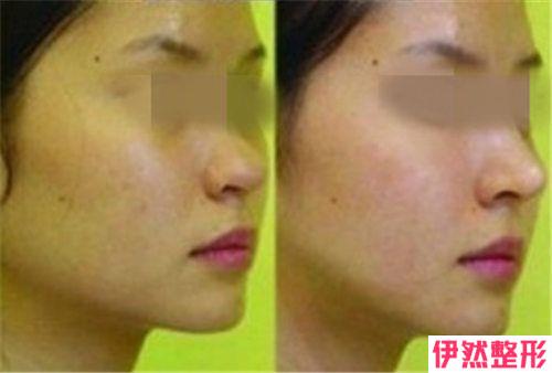 面颊黑痣消除有哪些术后护理