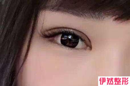 韩式微创高分子双眼皮术果可以有保持多久呢