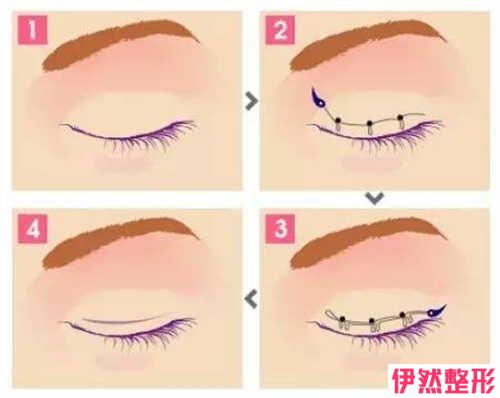 埋线法双眼皮会影响正常生育吗