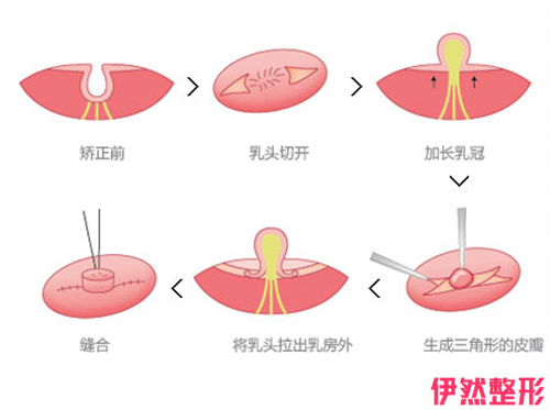 应该如何鉴别乳头内陷的类型