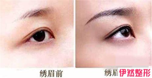 眉弓隆高原理及适合人群