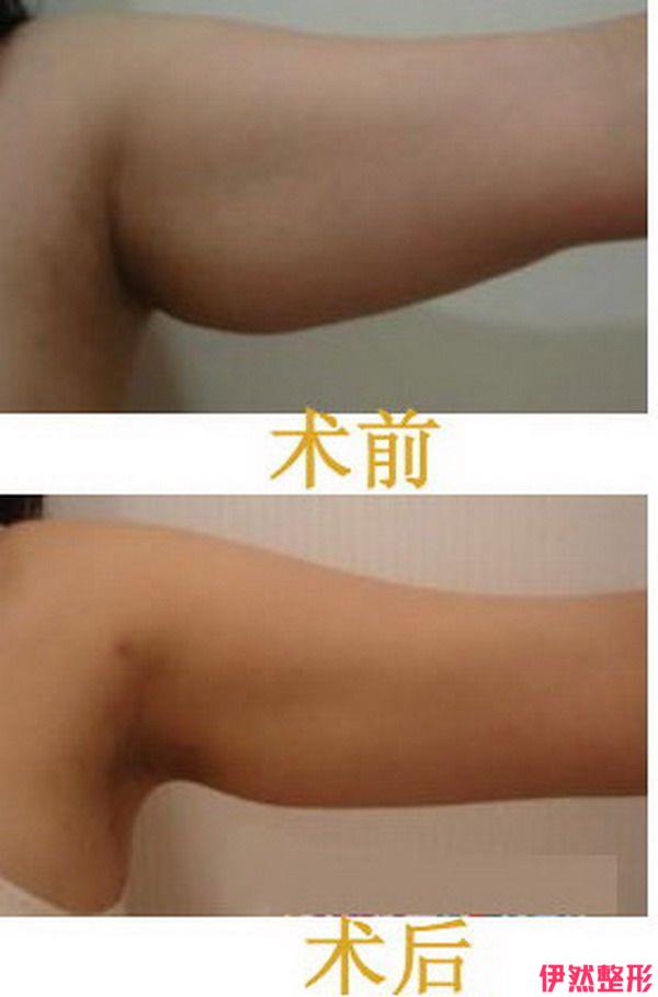 减手臂较快的方式有哪几种