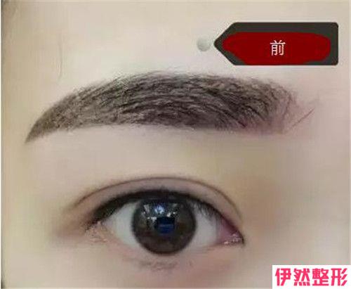 单眼皮纹眼线术后能持续5年吗