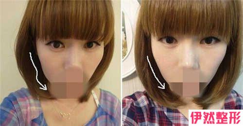 哪一些爱美妹子能施用注射除皱去除皱纹