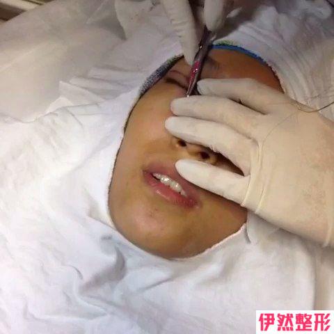 哪个双眼皮方法可以*有果的