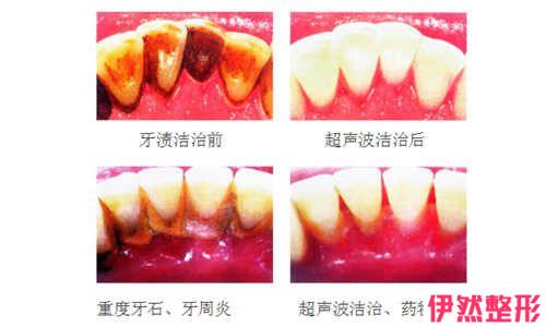 喷砂洁牙价格至少需要多少钱